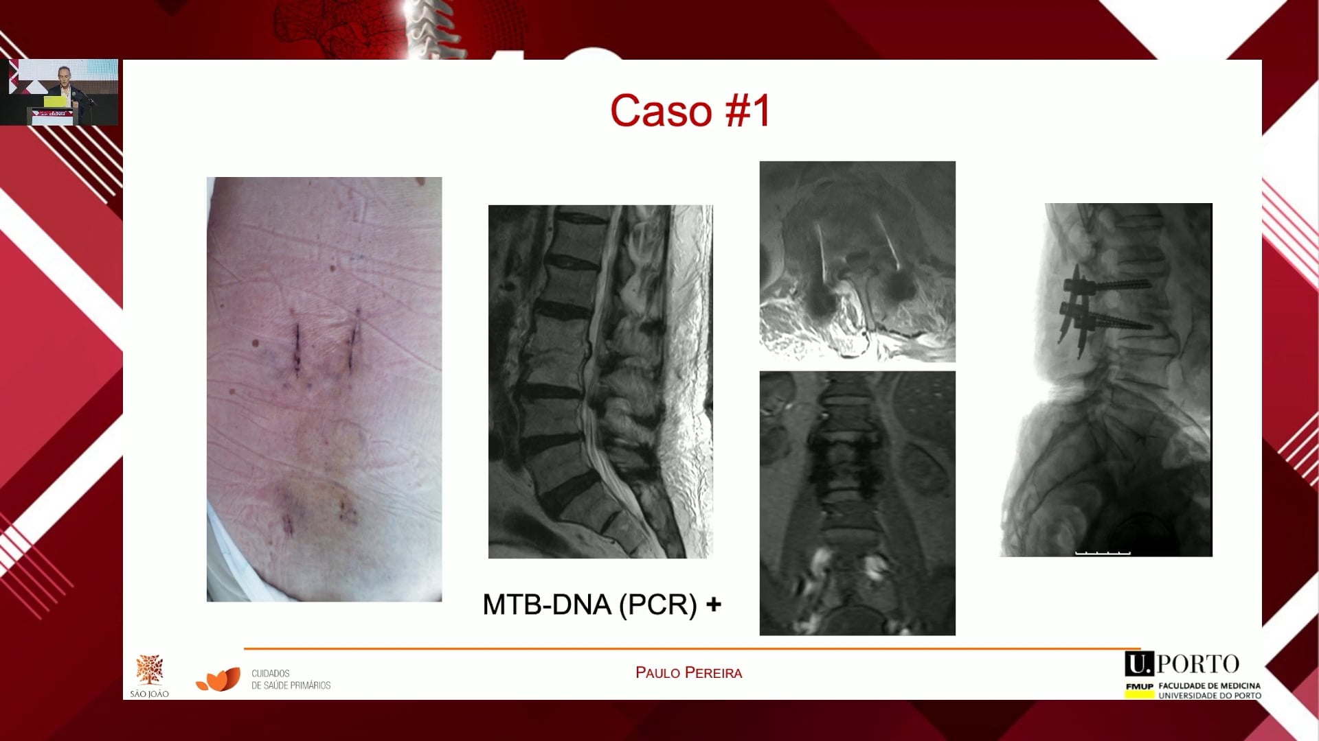 El papel del MIS en las infecciones de la columna vertebral