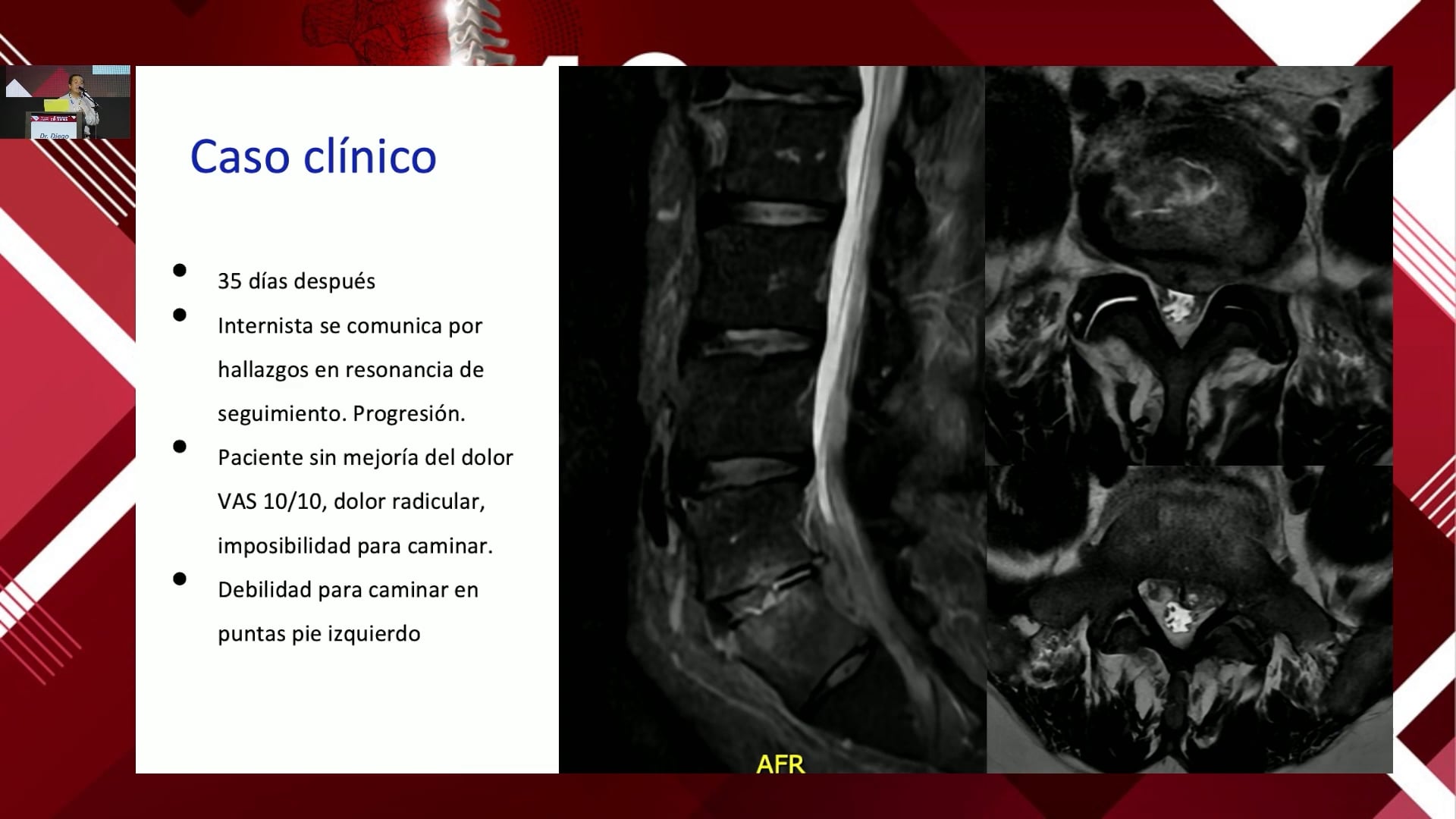Manejo endoscópico de la espondilodiscitis