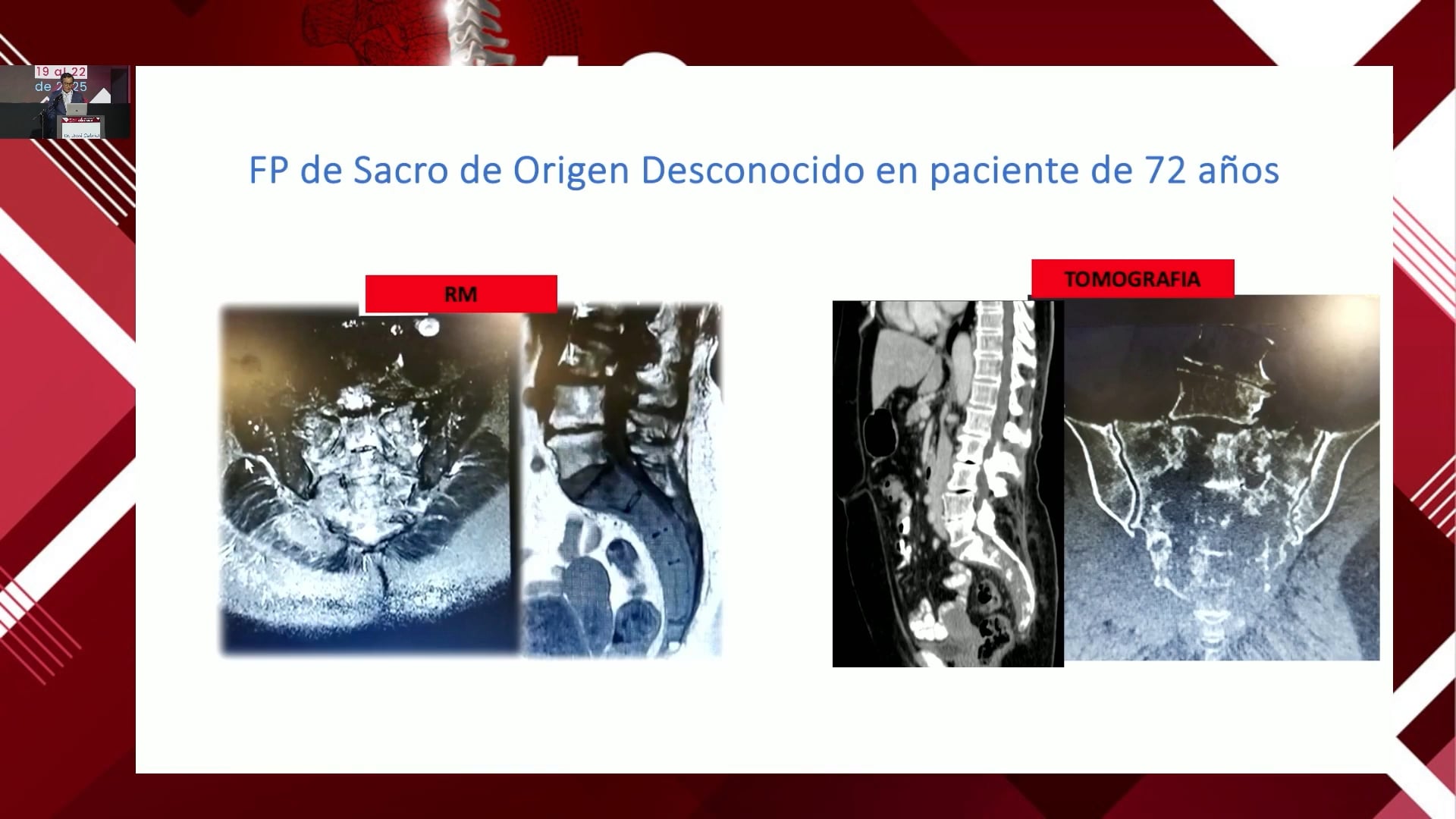 Tratamiento de la fractura patológica de columna vertebral