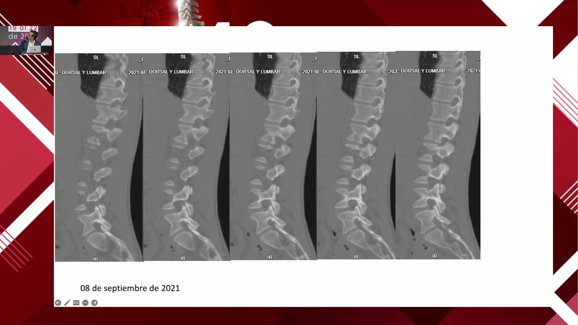Fracturas vertebrales en deportistas de alto rendimiento