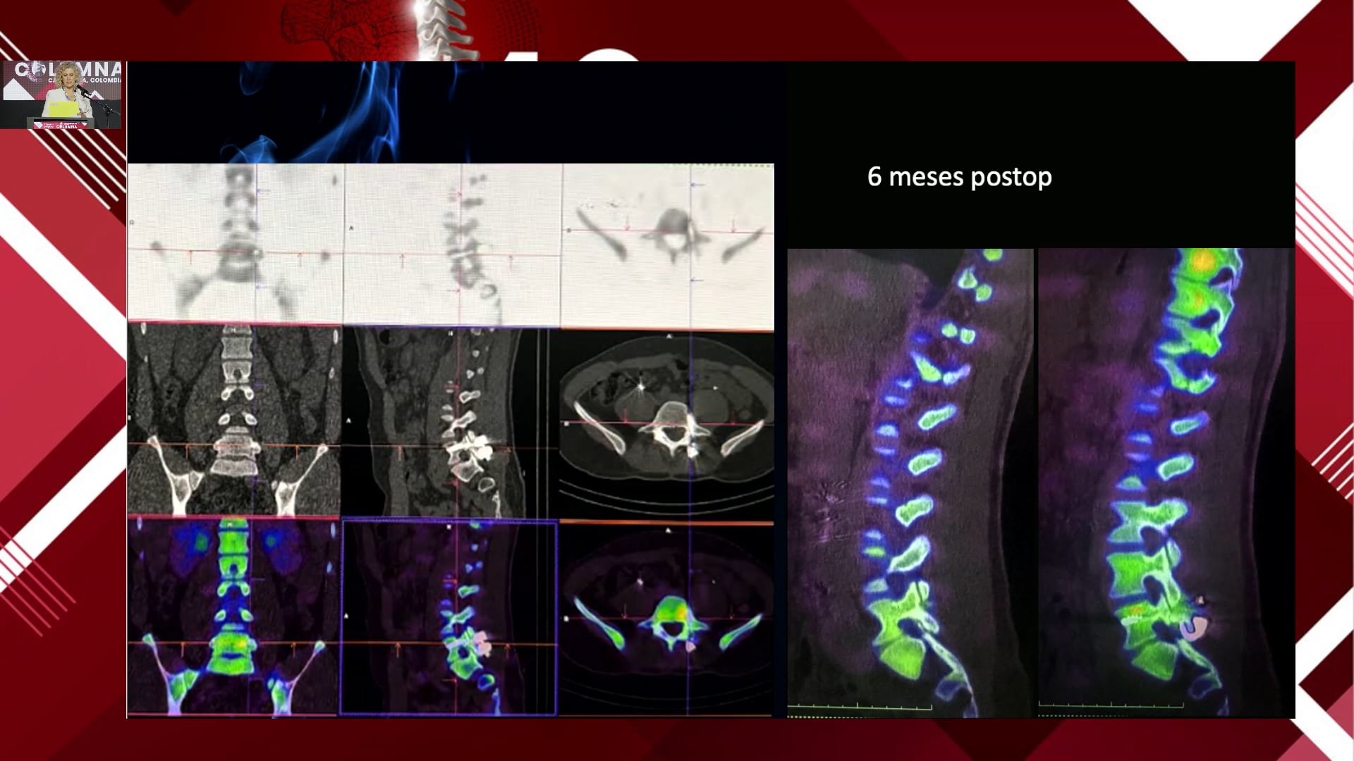 Espondilosis y espondilolistesis en deportistas de alto rendimiento