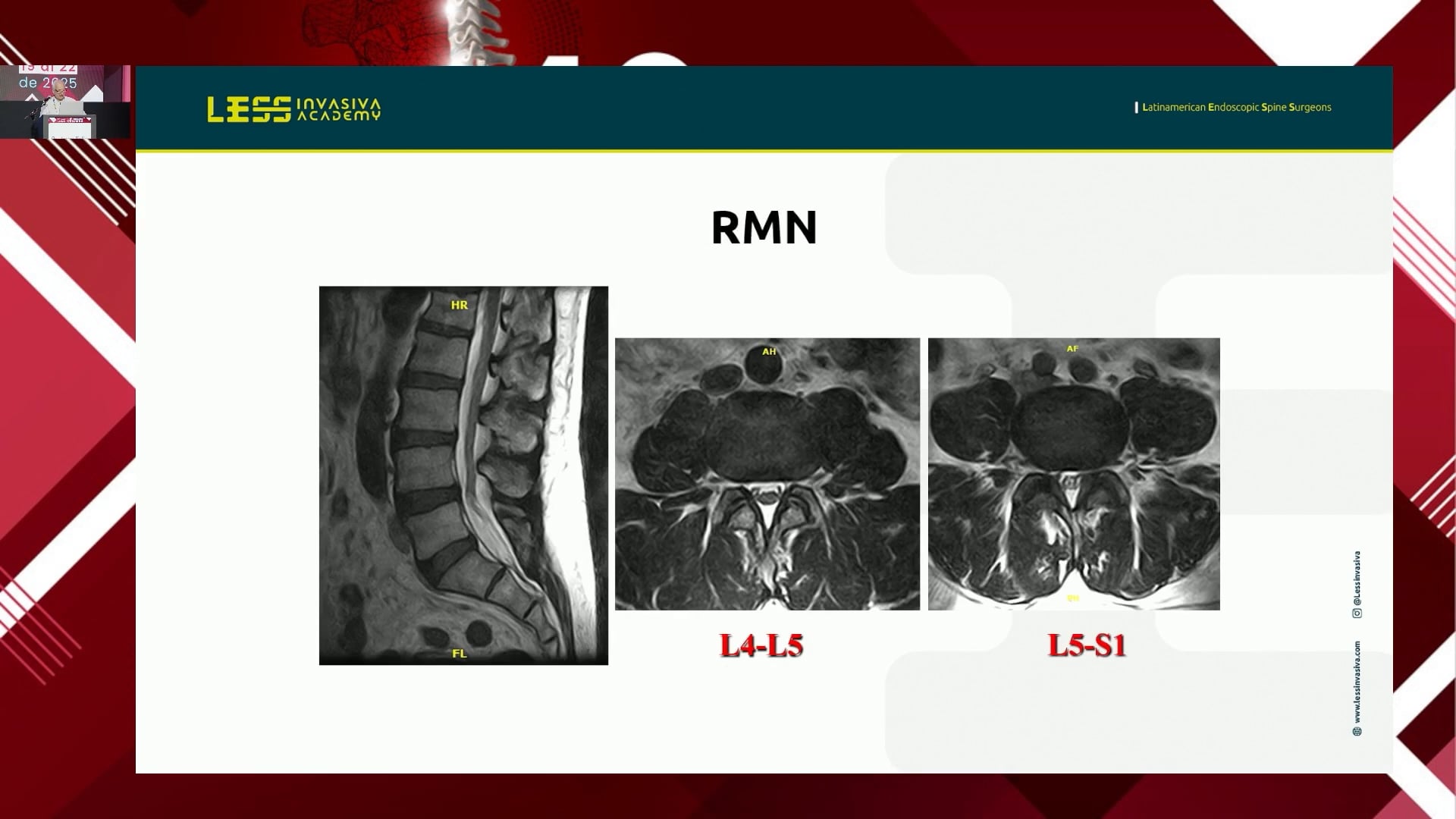 Lesiones discales cervicales en deportistas de alto rendimiento