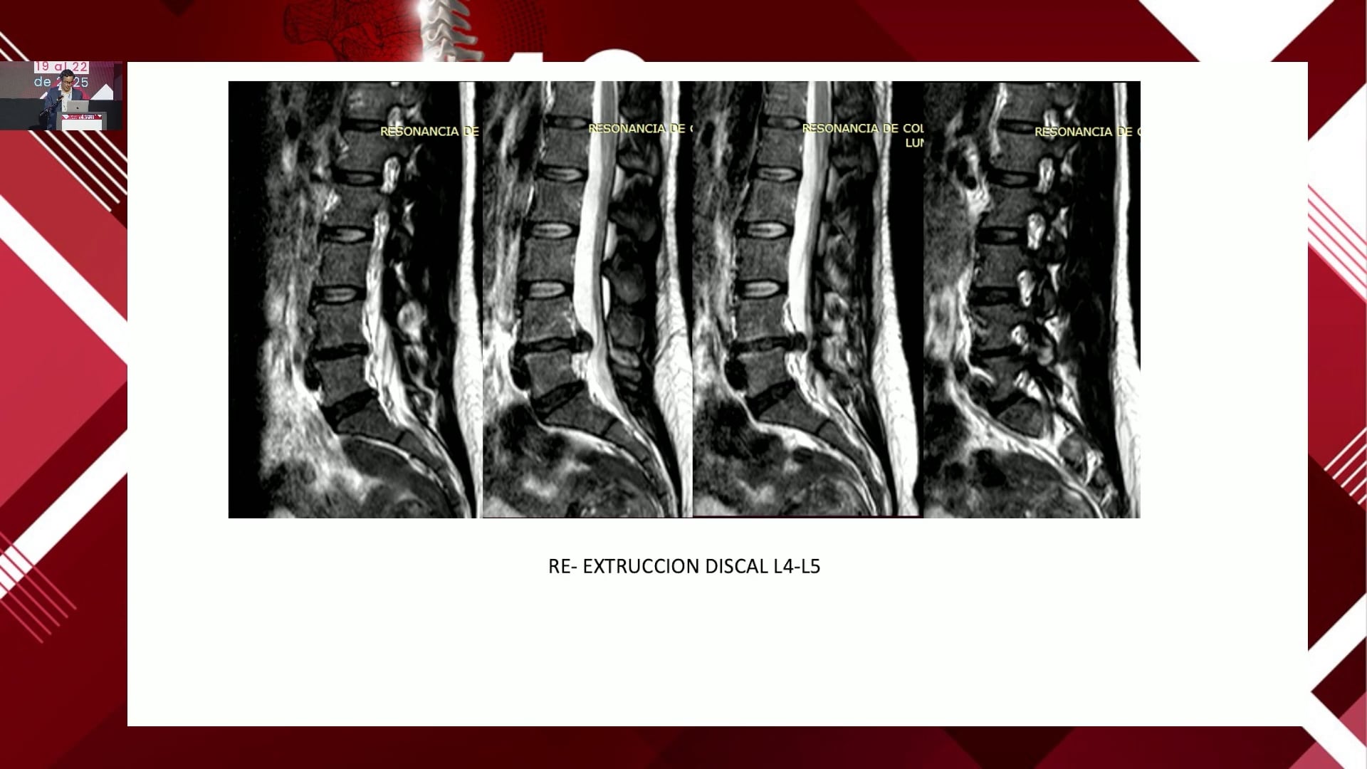 Full endoscopia en el paciente atleta