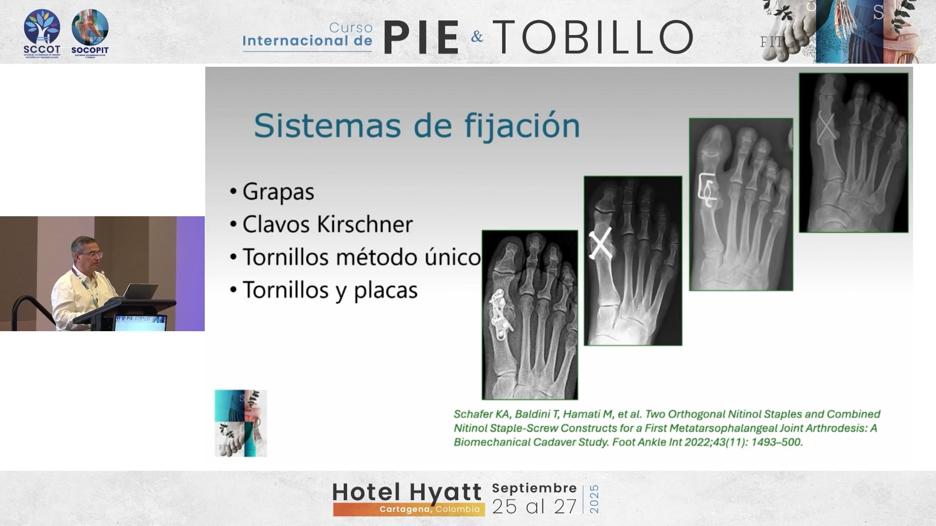 Artrodesis en Hallux rigidus