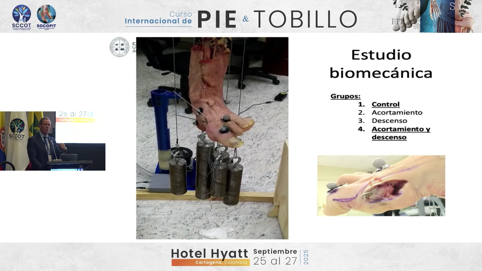 Osteotomías en Hallux rigidus