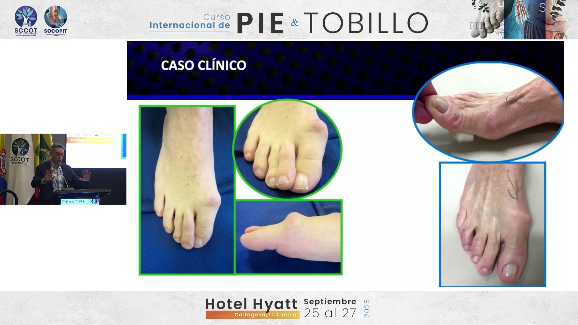 Artroplastia en hallux rigidus