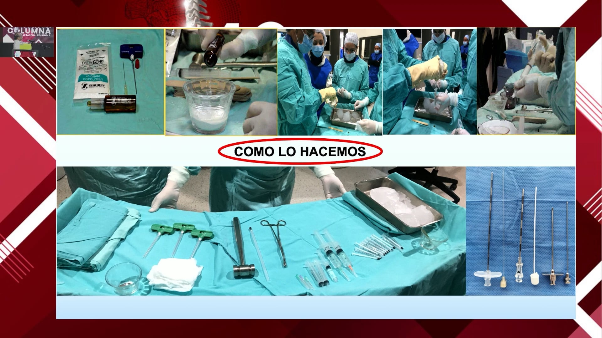 Manejo de metástasis óseas en columna espinal