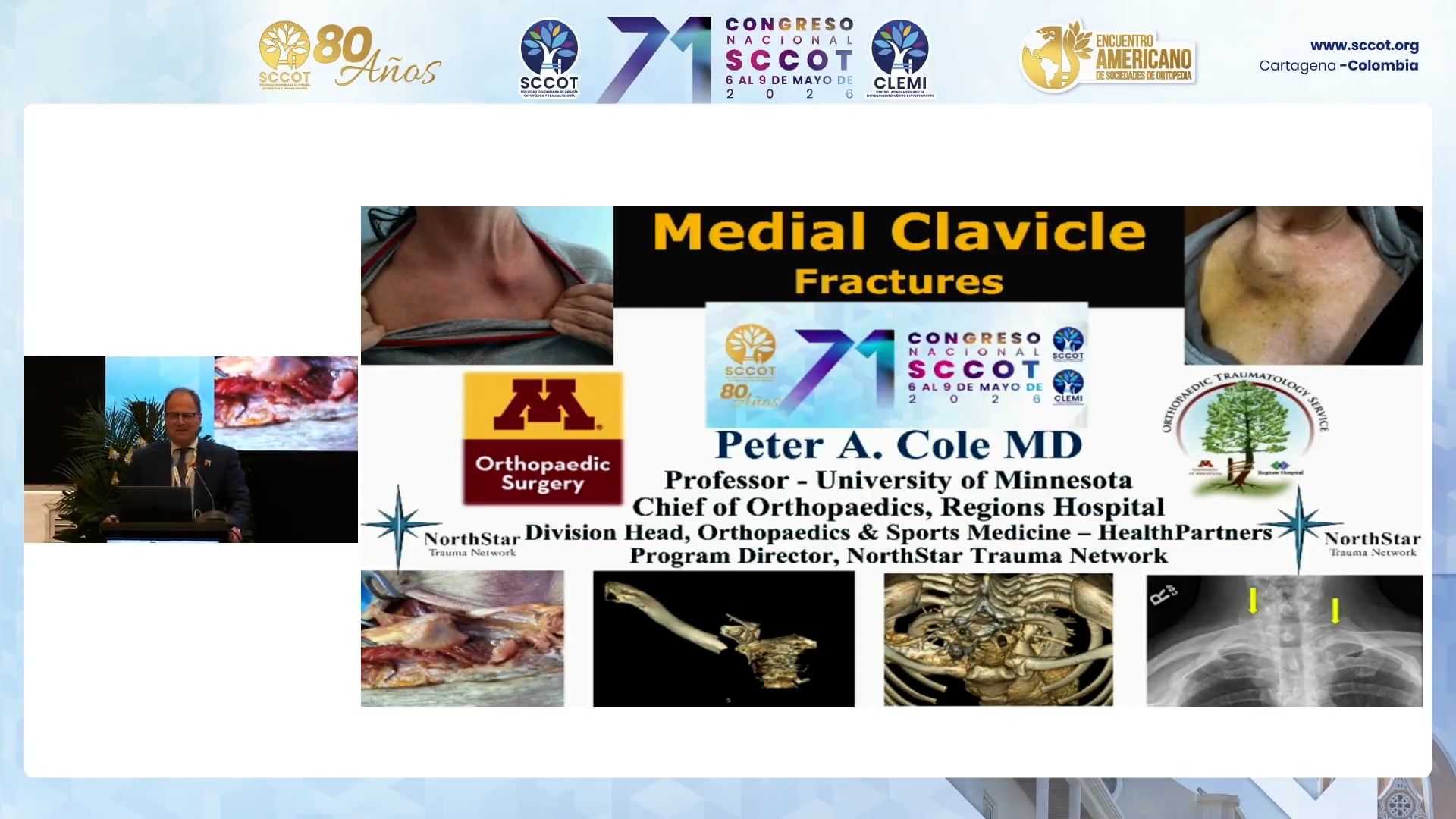 Fracturas de Clavícula Medial: Tratamiento y Casos