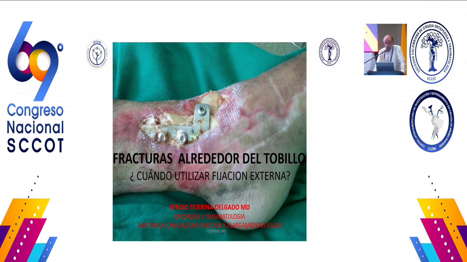 Tratamiento de lesiones alrededor del tobillo fijación externa circular luxaciones, fracturas maleolares y pilón tibial