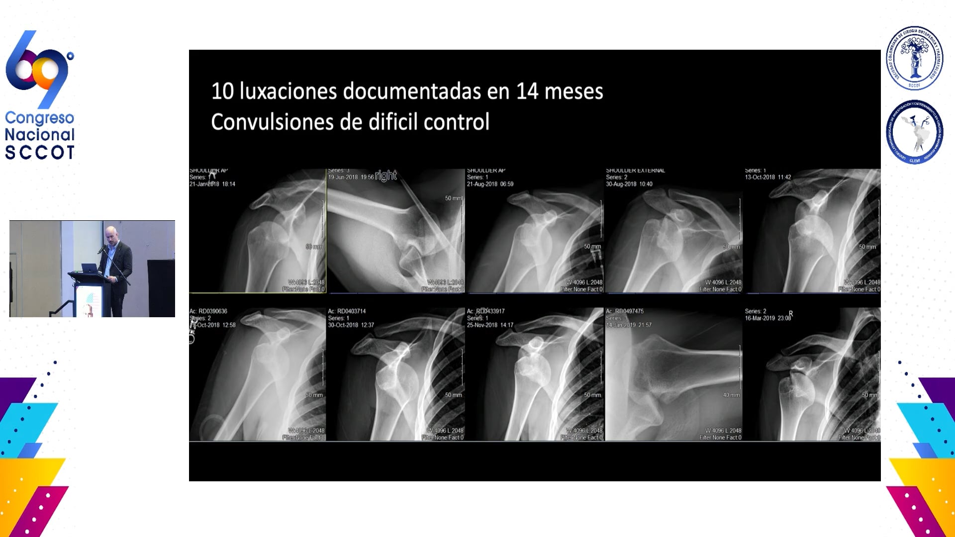 Concepto actual Manejo de defecto oseos en inestabilidad glenohumeral