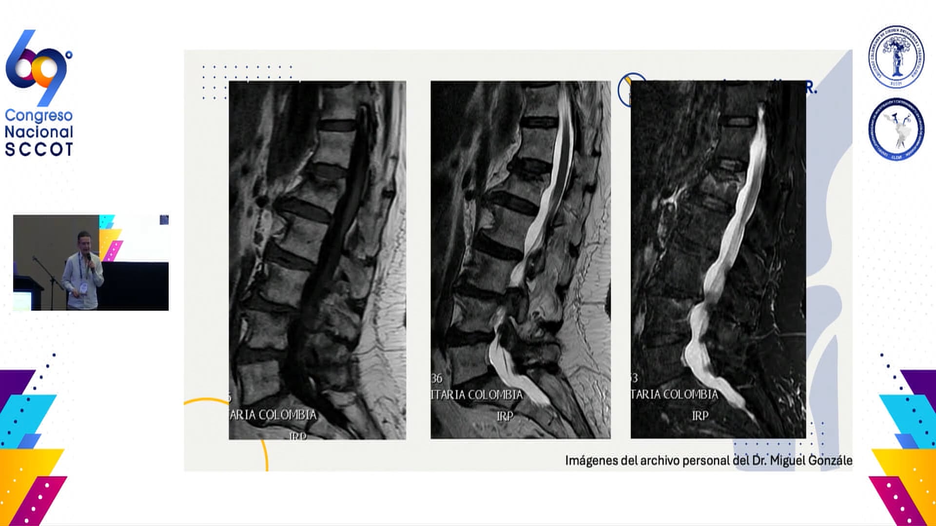 Osteoporosis Diagnóstico clínico, pruebas laboratorio estudios imagenológicos (Densitometría unidades Hounsfield) y manejo