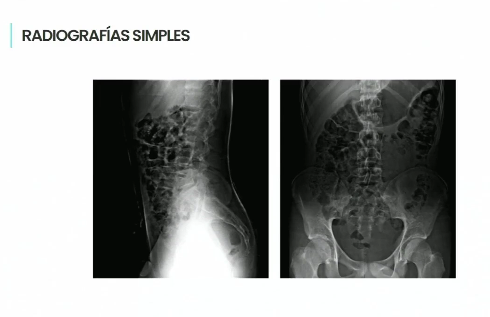 Tratamiento quirúrgico exitoso de fractura vertebral en adolescente tras caída de trampolín