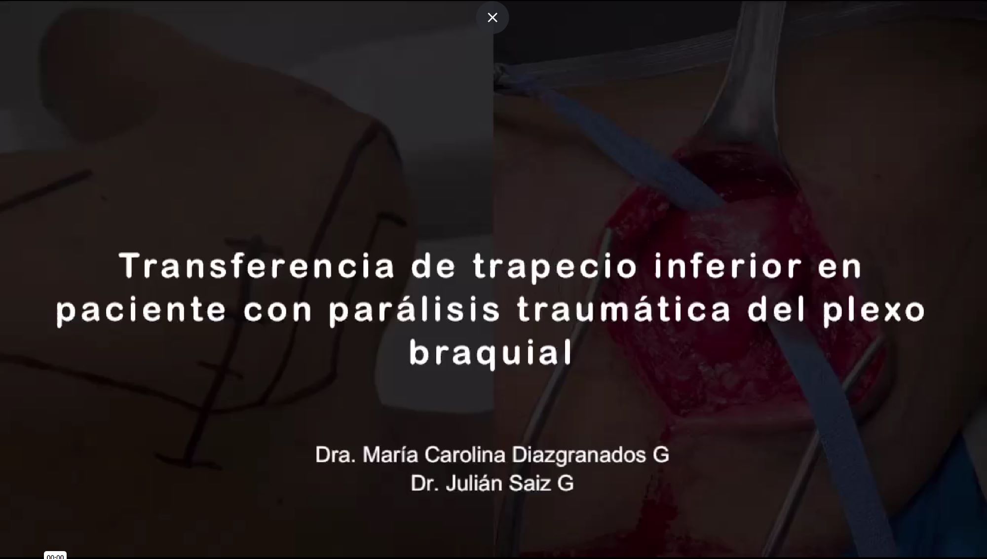 Transferencia de trapecio inferior en paciente con parálisis traumática del plexo braquial