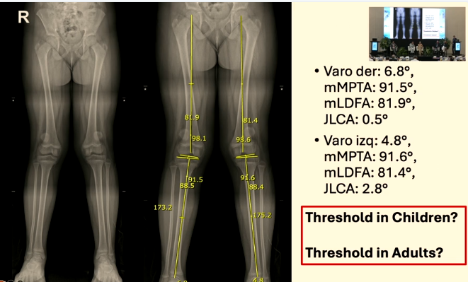 Inestabilidad Patelofemoral Caso Clínico