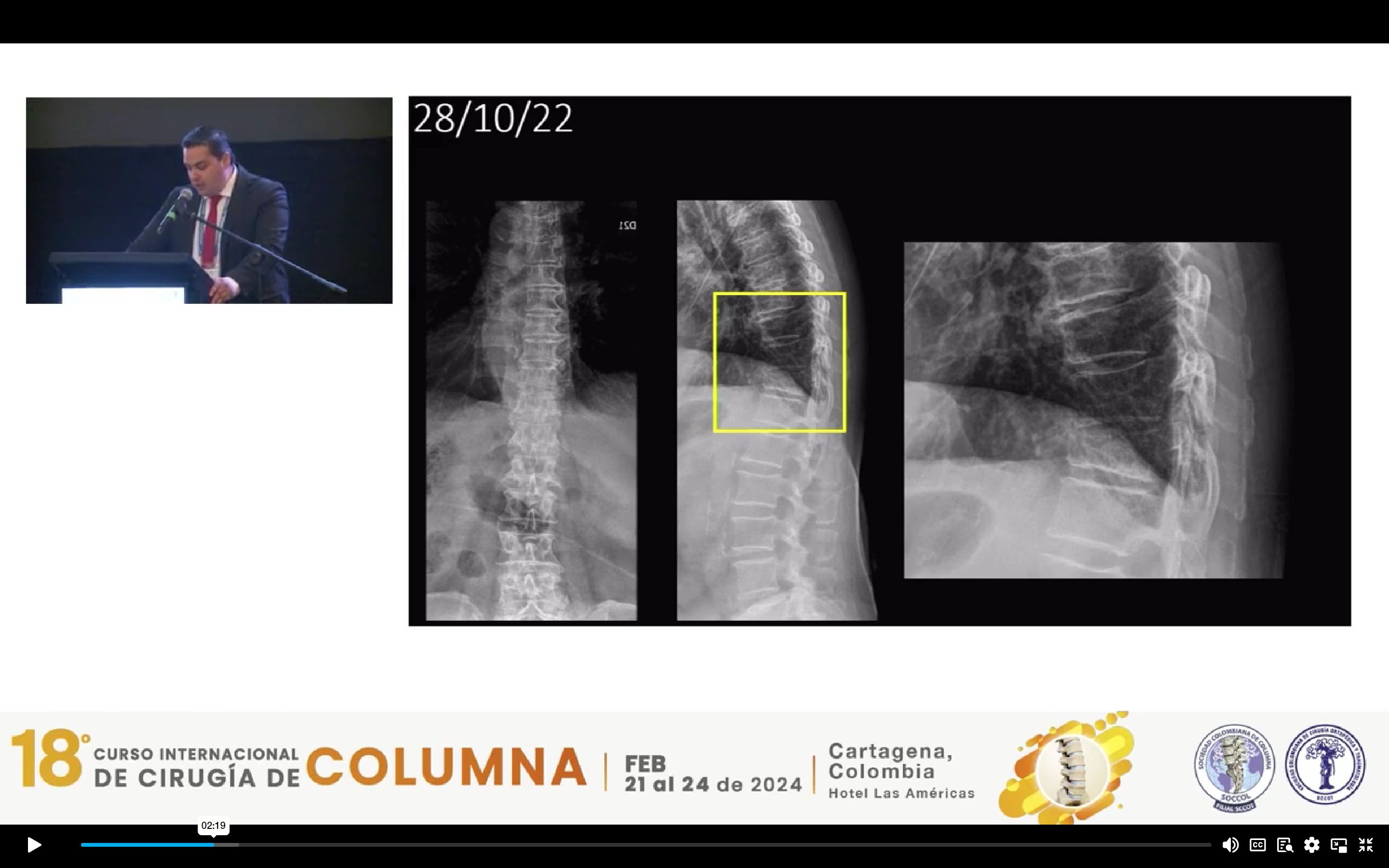 Espondilodiscitis Torácica Complicada: Hallazgos Clínicos y Consideraciones Quirúrgicas